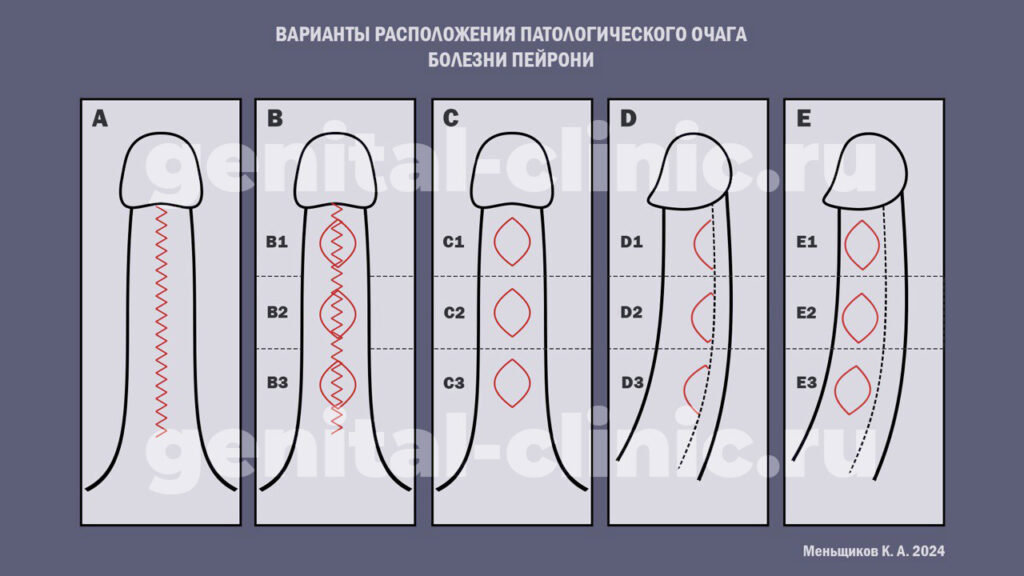 варианты расположения фиброзных очагов на члене