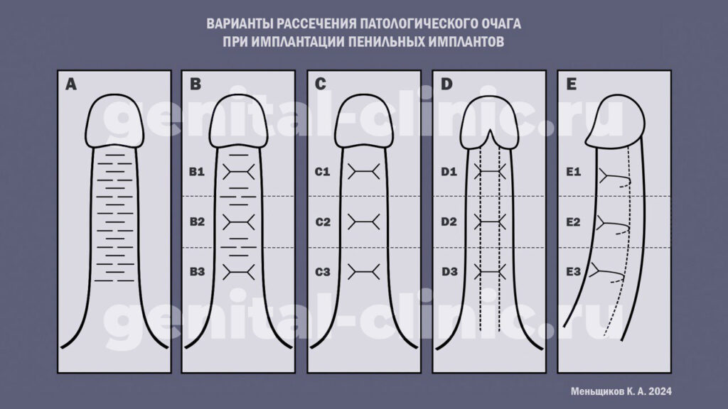 варианты рассечения фиброзных бляшек при операции Пейрони